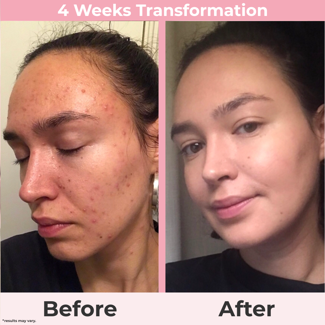 PoreBalance Serum — Clearer, Smoother Skin in Weeks
