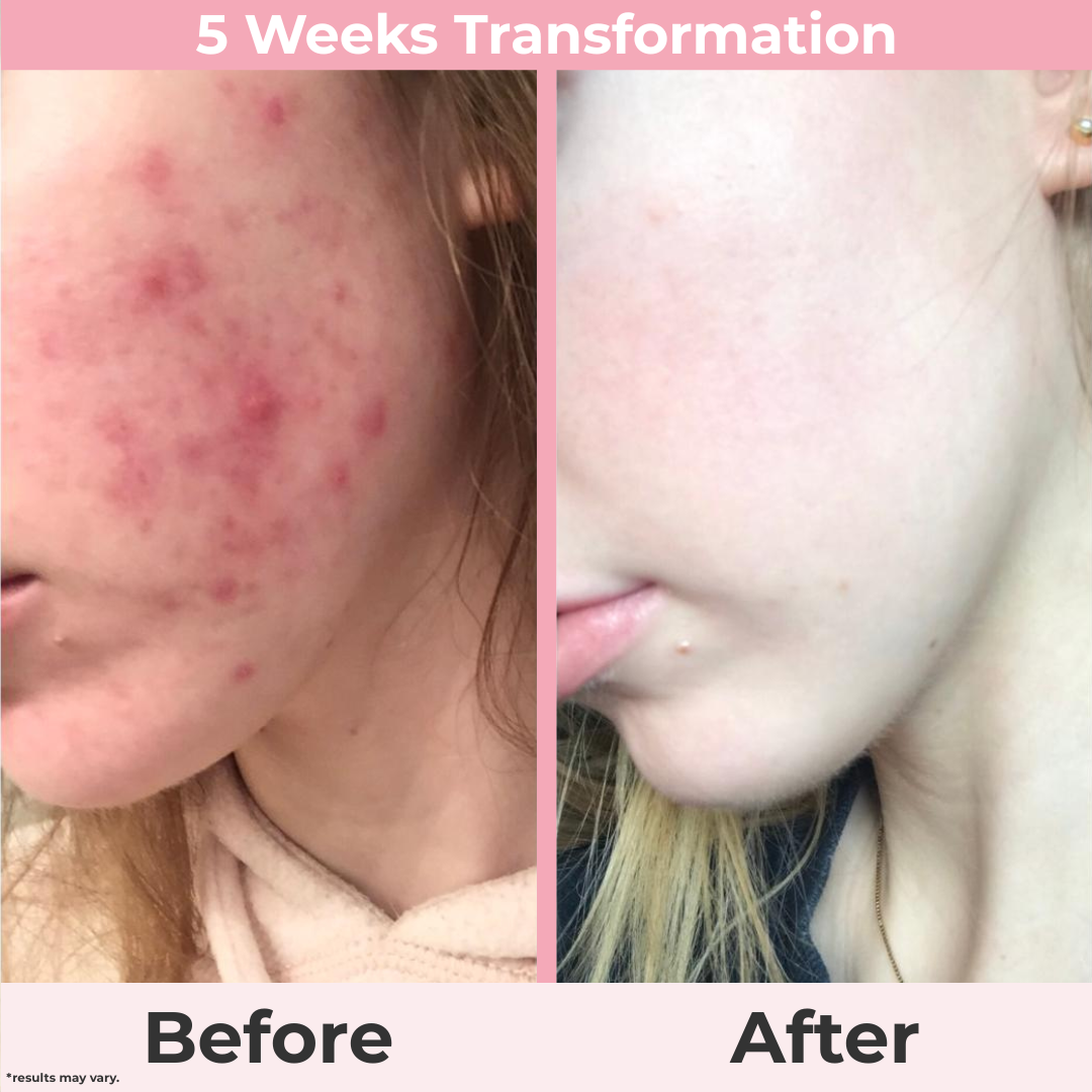 PoreBalance Serum — Clearer, Smoother Skin in Weeks