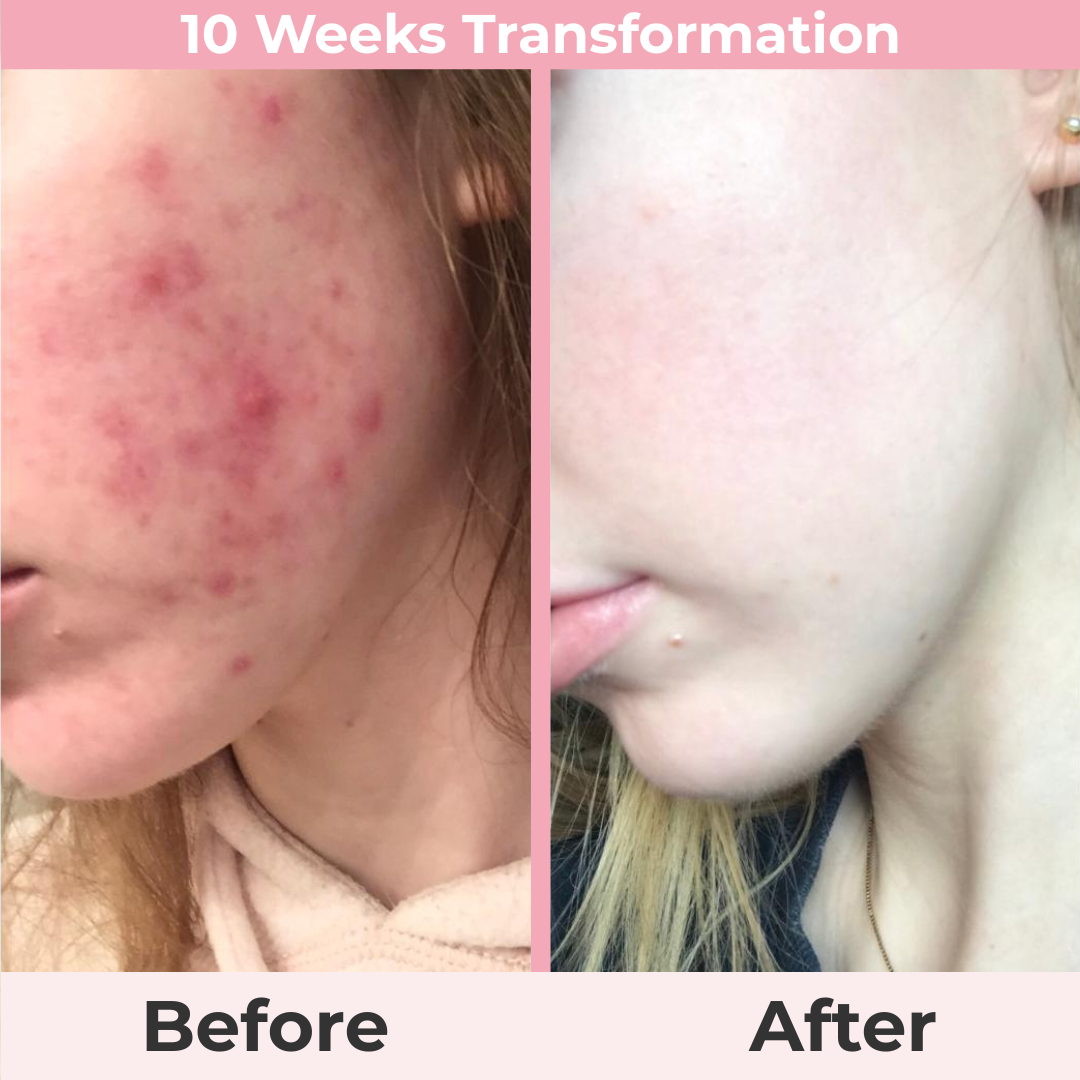 Aura Renew Wand — Clear Acne, Smooth Wrinkles & Renew Hair
