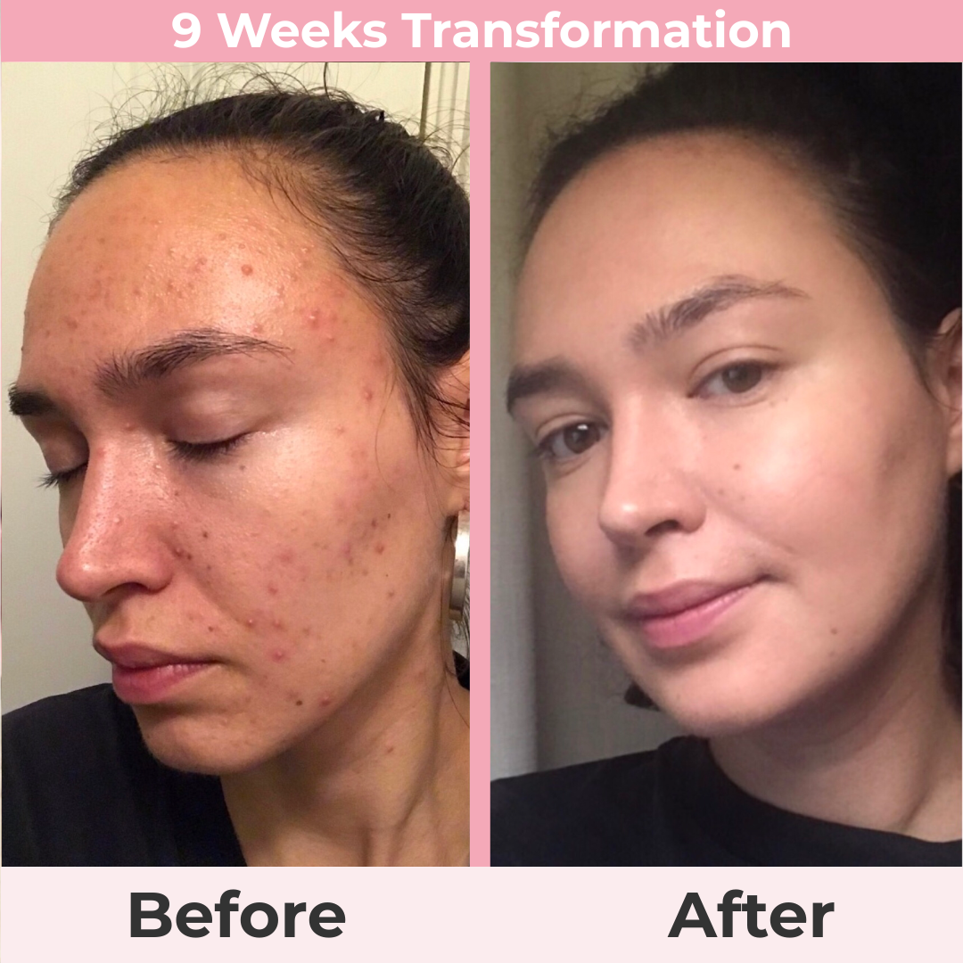 Aura Renew Wand — Clear Acne, Smooth Wrinkles & Renew Hair